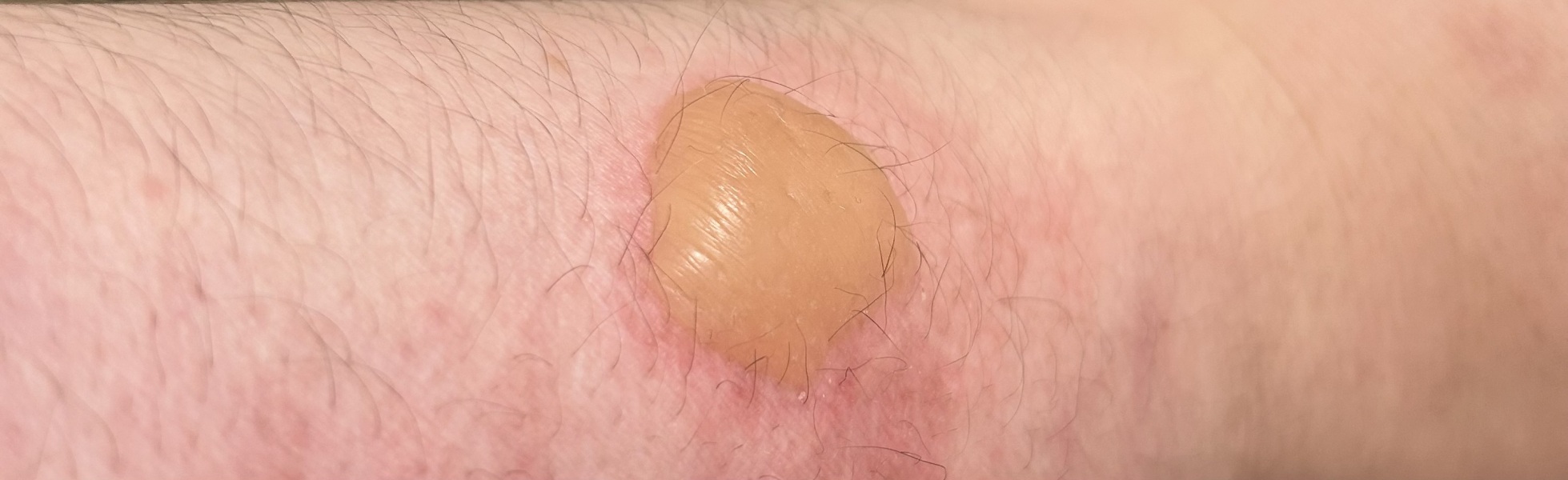 Does this burn look okay