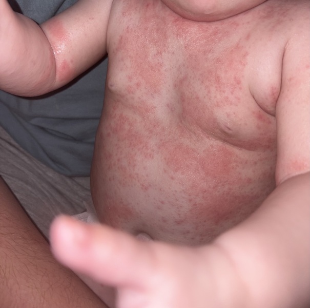 Eczema help!