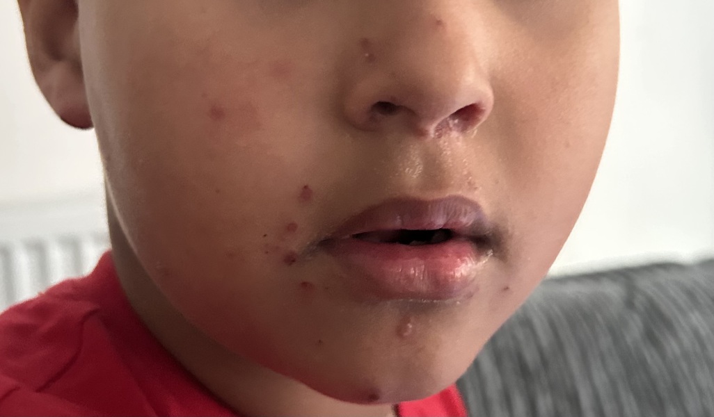 Does this looks like a chickenpox??