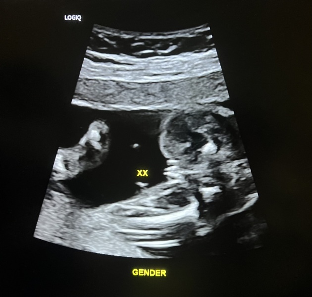 20 weeks 5 days potty scan. Is baby definitely a girl?