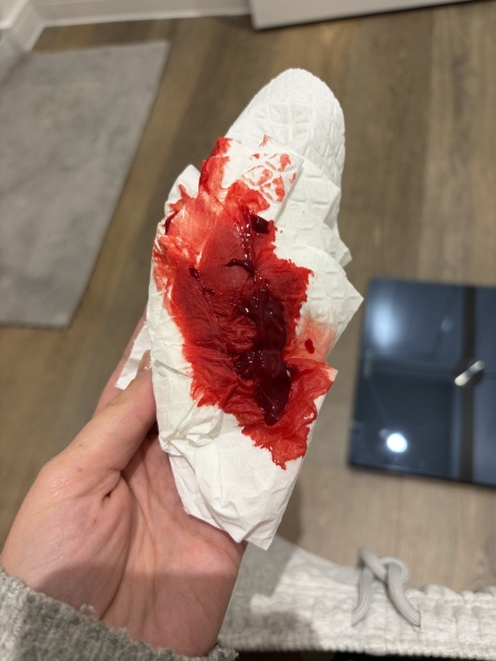 Bleeding and clots after cervical ectropion cauterisation: should I seek advice?