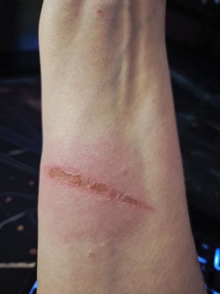 Is this burn infected?