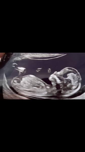 13 week scan, any ideas on the gender?