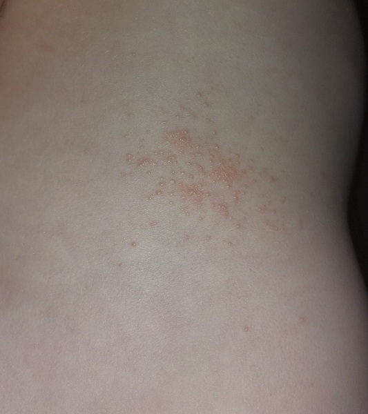 Raised rough rash