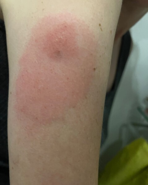 Why am I reacting so badly to gnat bites this year?