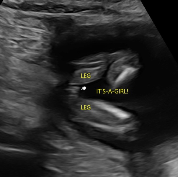Gender scan confirmation?