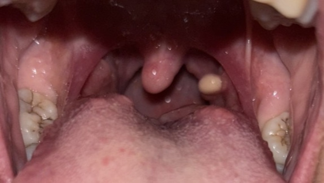 Tonsil stones