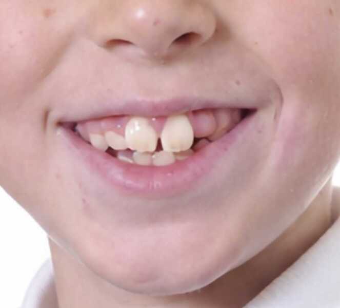 Dentist advice - adult tooth not coming through?