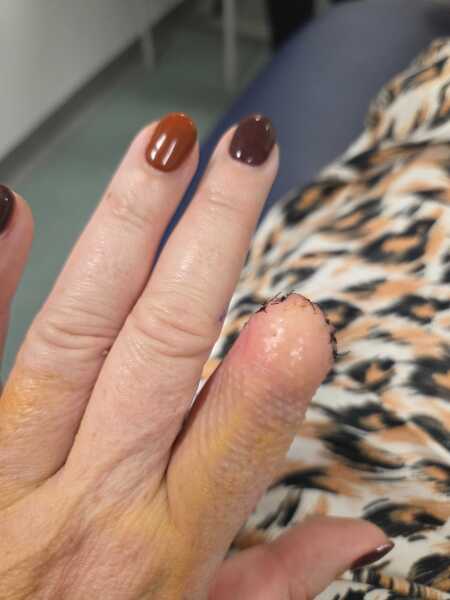 Finger amputation need a hand hold.