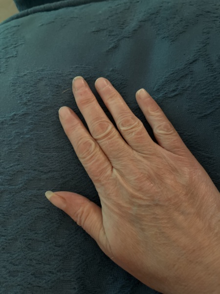 Finger amputation need a hand hold.