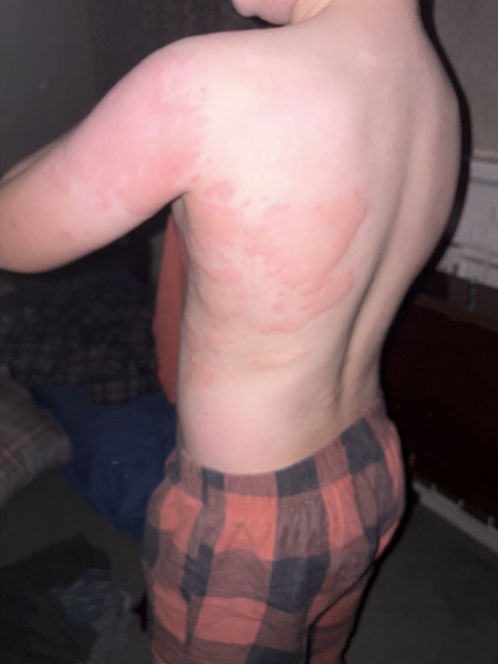 Weird virus with hives, any other families had this? Pic