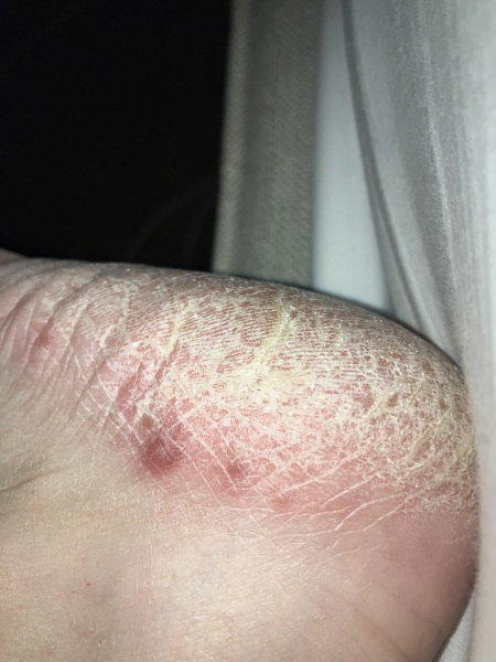 Athletes foot or Pompholyx?