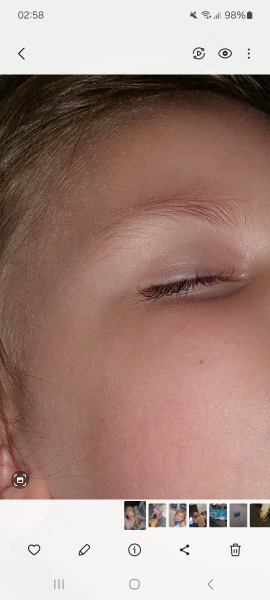 Worrying about purple/blue color on eyelids when asleep