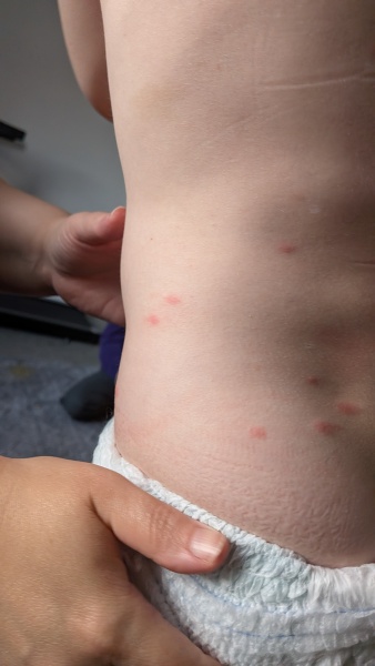 AIBU to think my child got flea bites at his dad's?