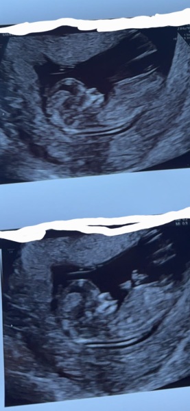 12 weeks scan nub??
