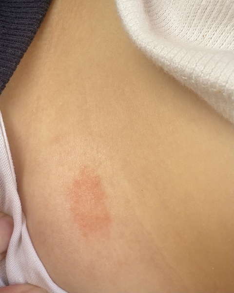 Ringworm?