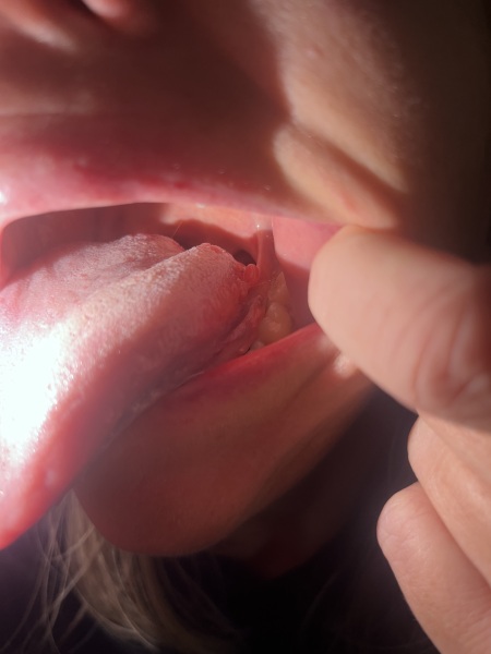 Lump of tongue