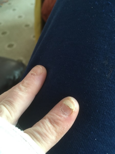 Does this look like a fungal nail infection?