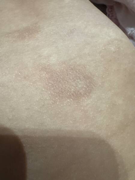 Baby’s dry skin patches – eczema or cow’s milk allergy?