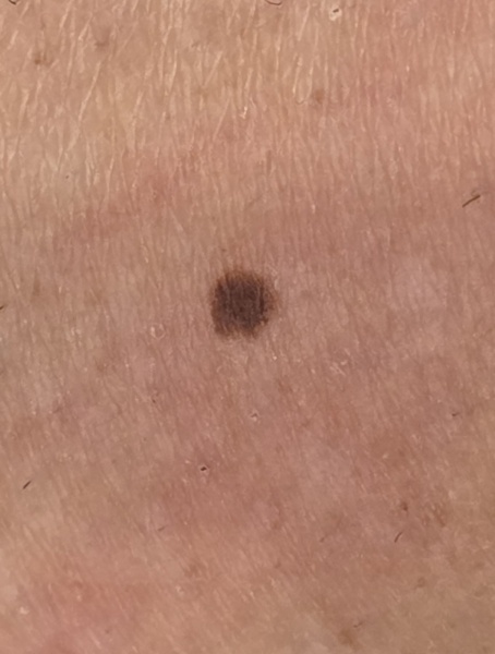 Would you get this mole checked?