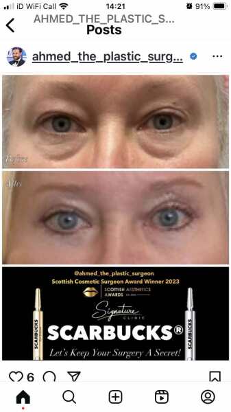 Lower eye cosmetic surgery