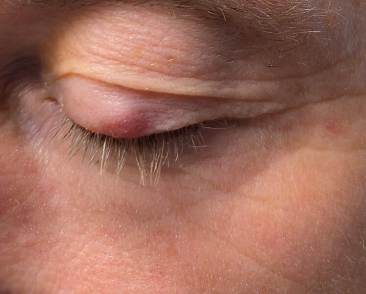 What's this on my eyelid ?