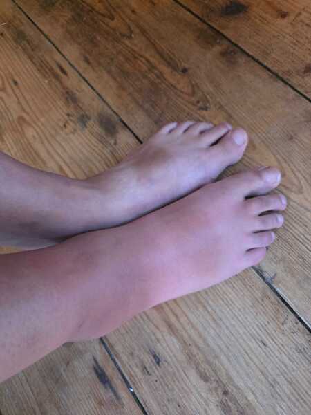Mosquito bite, swollen ankle, pic included