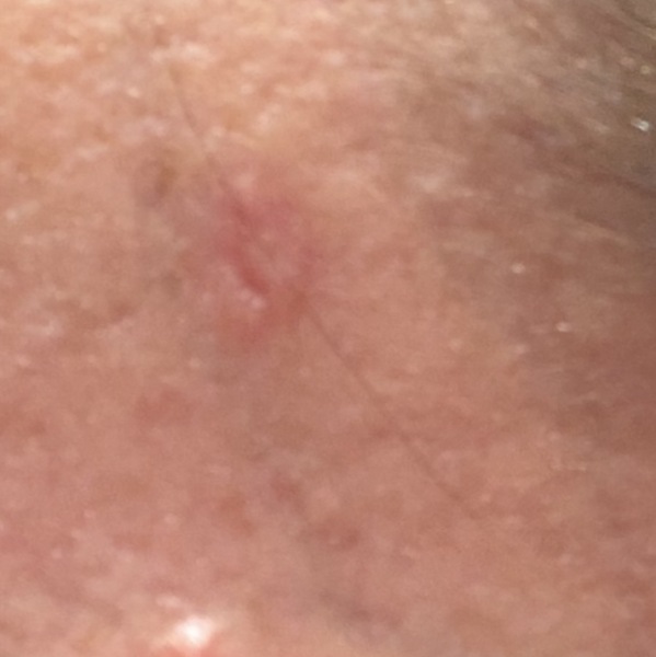 Any dermatologists? Panicking
