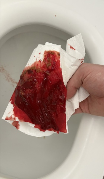 16 year old with bleeding and frequent bowel movements