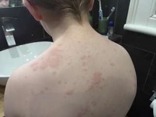Weird virus with hives, any other families had this? Pic