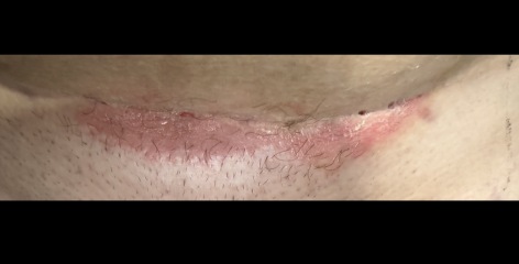 C section infection