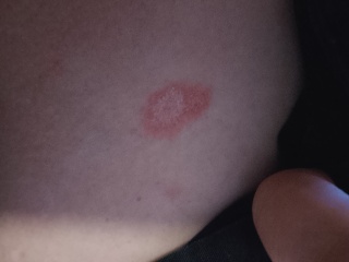 Odd spots on breast