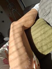 Skin condition taking over my life