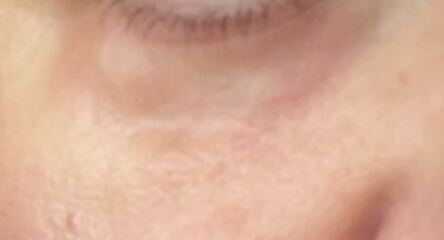 Totally fed up with this skin issue under eyes now, awaiting telepathway dermatology review pics attached
