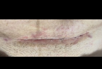 C section infection