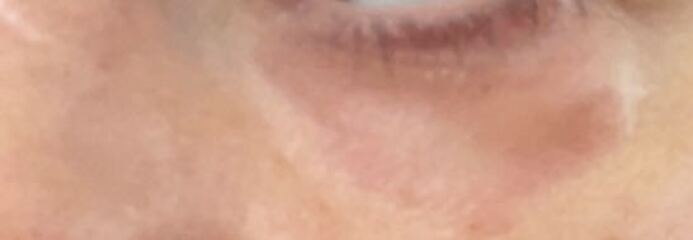 Totally fed up with this skin issue under eyes now, awaiting telepathway dermatology review pics attached