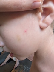 What could be causing recurring itchy spots across the whole family?