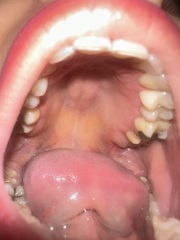 Bump roof of mouth