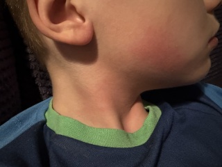 What’s this rash on my DS?