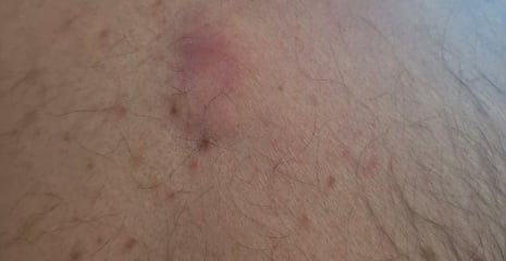 Husband's back cyst in all its glory