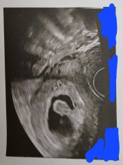Can anyone explain an unusual finding on my early pregnancy scan?