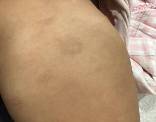 Baby’s dry skin patches – eczema or cow’s milk allergy?
