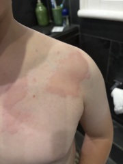 Weird virus with hives, any other families had this? Pic