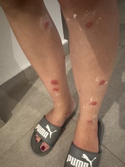Reaction to mosquitoe bites