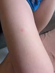 What could be causing recurring itchy spots across the whole family?