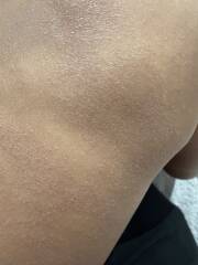 Baby’s dry skin patches – eczema or cow’s milk allergy?