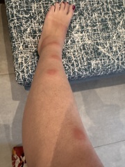 Reaction to mosquitoe bites