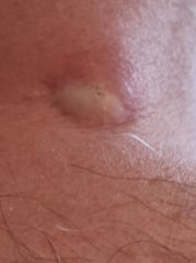 Husband's back cyst in all its glory