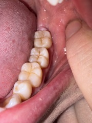 Any dentists around? What’s this at the back of my tooth?