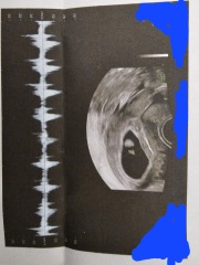 Can anyone explain an unusual finding on my early pregnancy scan?